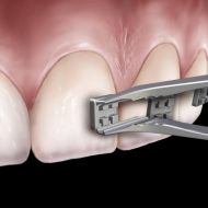 Pince ortho précelle à bague 